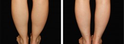 caviglie sottili: Liposuzione
