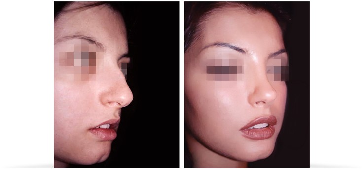 La profiloplastica, prima e dopo l'intervento di chirurgia estetica