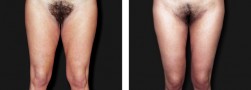 Il lifting delle cosce: ginocchio, cosce e genitali