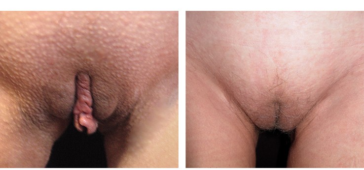 Chirurgia genitali femminili: lipostruttura delle grandi labbra