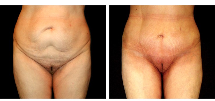 Liposuzione pube - Lifting monte di venere