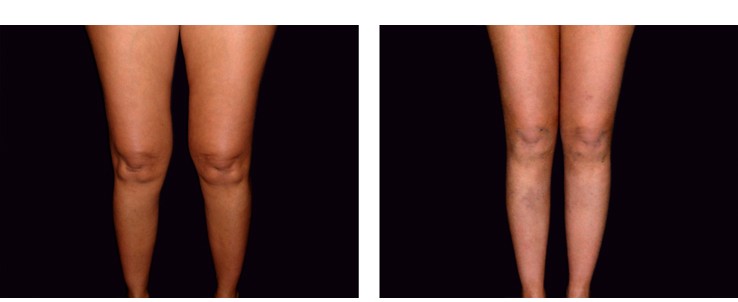 La liposuzione delle ginocchia. Dimagrimento del ginocchio