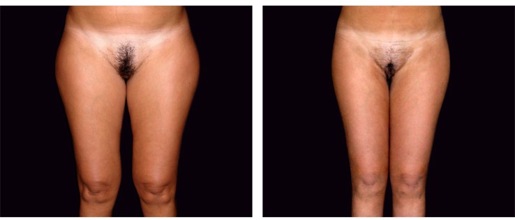 La liposuzione delle cosce e il thigh-gap