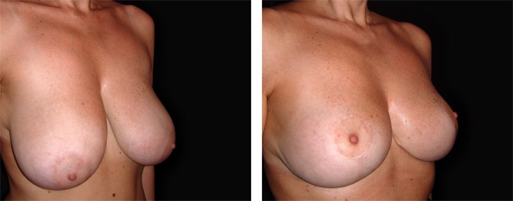 La Mastopessi, chirurgia plastica estetica per sollevamento del seno