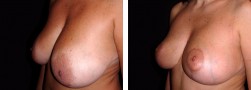 Aumento e sollevamento seno: la Mastopessi