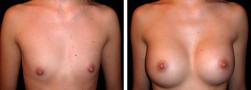 Mastoplastica: intervento per aumento del seno