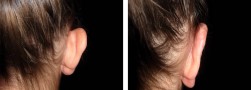 Esiti intervento di otoplastica orecchie: ragazza, vista posteriore