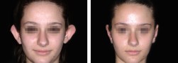 Esiti intervento di otoplastica orecchie: ragazza, vista anteriore