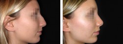 Rifacimento del naso: la rinoplastica